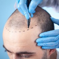hairtransplant12